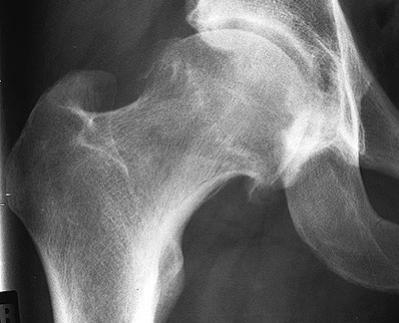 Abb. 2: Röntgenbild der rechten Hüfte eines 28-jährigen Mannes vor der Operation mit reaktiven, krankhaften Knochenanbauten am Übergang vom Schenkelhals zum Hüftkopf.